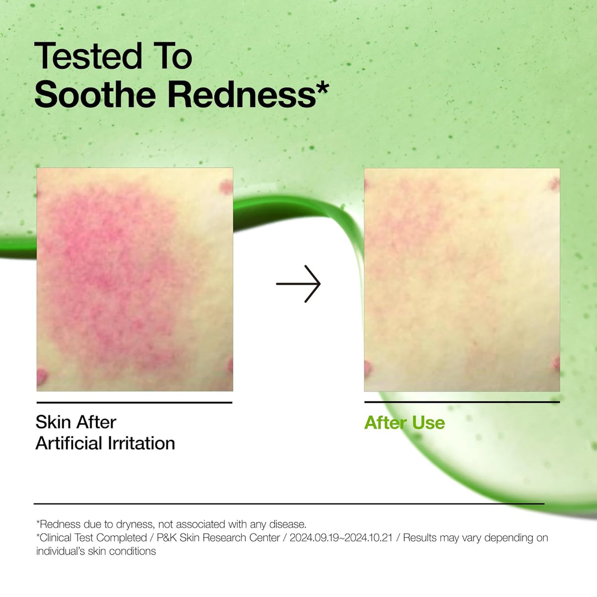 Anua Azelaic Acid 10  HYALURON REDNESS SOOTHING SERUM