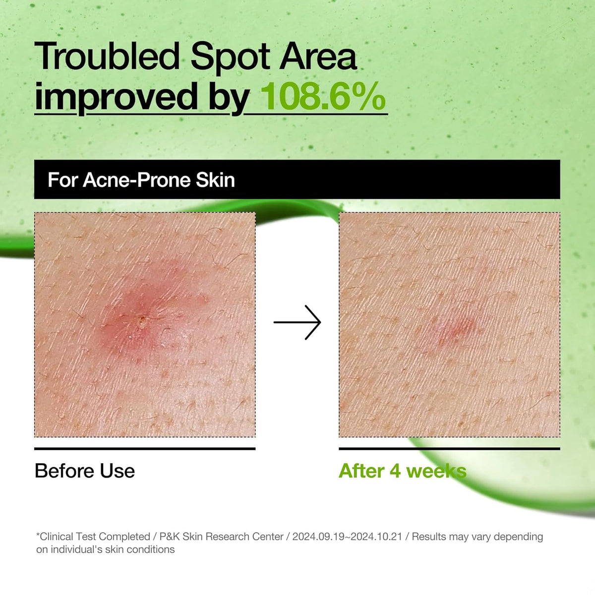 Anua Azelaic Acid 10  HYALURON REDNESS SOOTHING SERUM